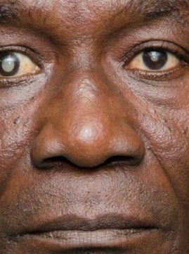 Cataract