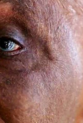 Glaucoma