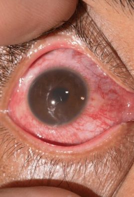 Uveitis